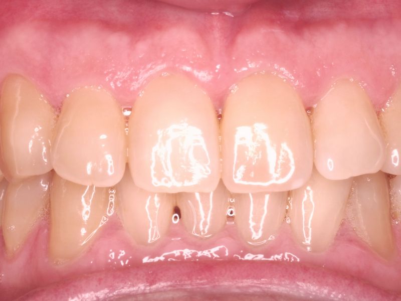 blanqueamiento dental después y antes