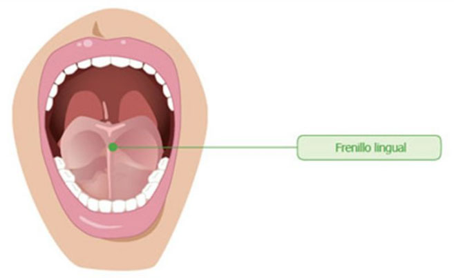 eliminar frenillo lingual mediante cirugía oral