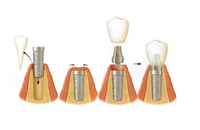 Proceso del implante dental