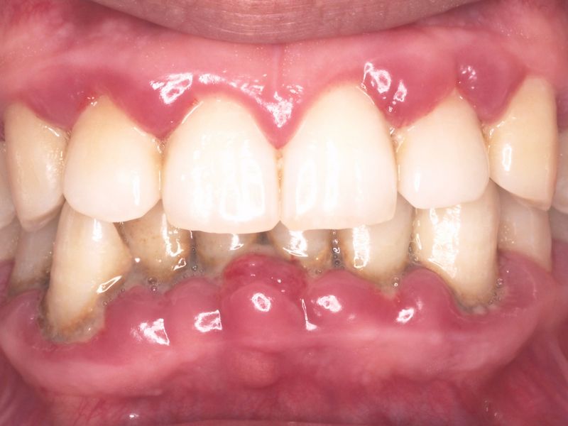 periodoncia antes. Casos clínicos dentales