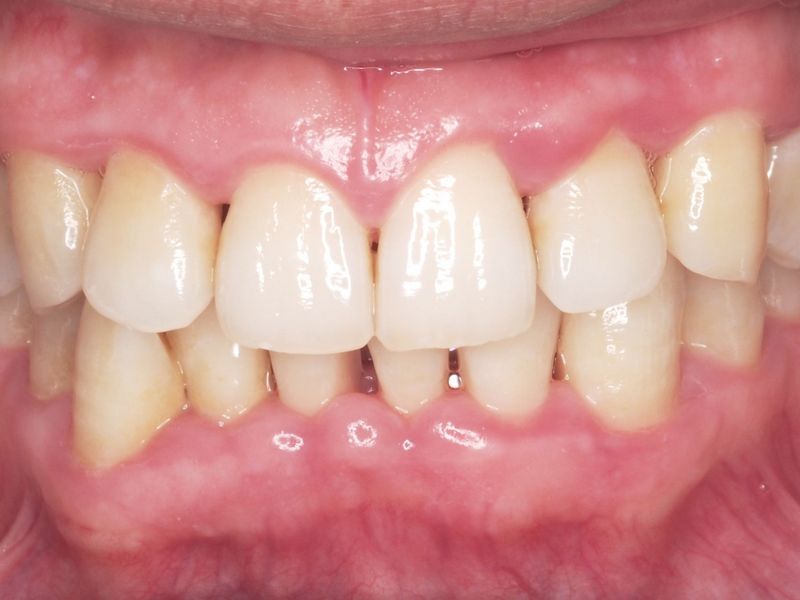 Periodoncia antes y después. Casos clínicos dentales