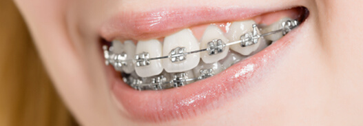 brackets ortodoncia tradicional metalicos