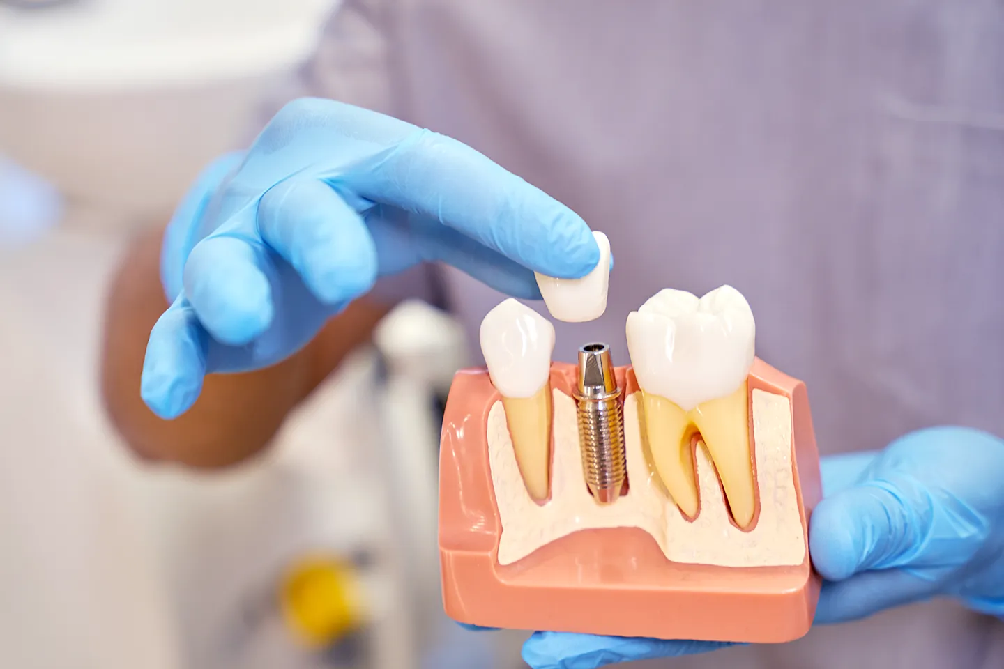 cuidados tras implante dental
